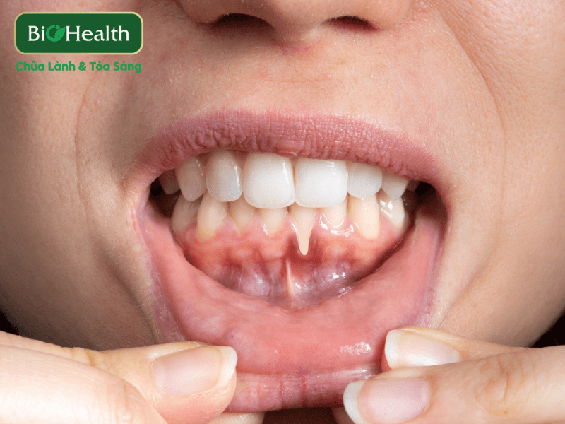 Viêm lợi – "Kẻ thù" thầm lặng của sức khỏe răng miệng - BioHealth