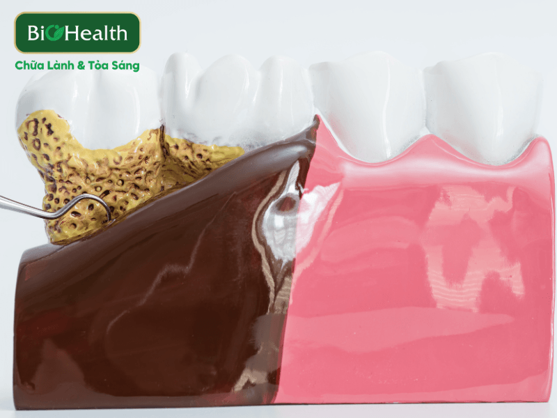 Các vấn đề răng miệng người lớn thường gặp và cách kem thuần chay giải quyết - BioHealth