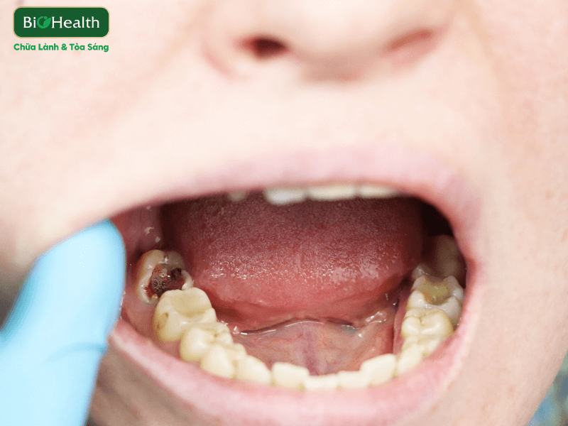 Tại sao khoang miệng lại là nơi "nhạy cảm" với hóa chất nhất? BioHealth